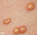 xanthogranuloma juvenile