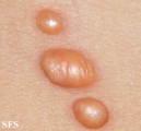 xanthogranuloma juvenile