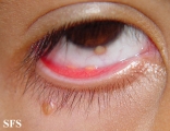 xanthogranuloma juvenile