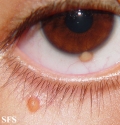 xanthogranuloma juvenile