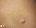 xanthogranuloma juvenile