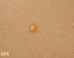 xanthogranuloma juvenile