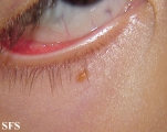 xanthogranuloma juvenile