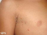 xanthogranuloma juvenile