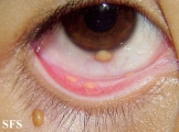 xanthogranuloma juvenile