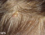 xanthogranuloma juvenile