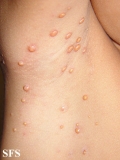 xanthogranuloma juvenile