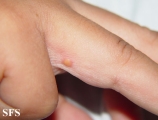 xanthogranuloma juvenile