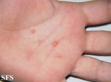 xanthogranuloma juvenile
