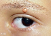 xanthogranuloma juvenile