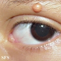 xanthogranuloma juvenile