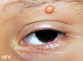 xanthogranuloma juvenile