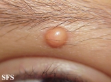xanthogranuloma juvenile