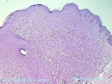 xanthogranuloma juvenile