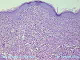 xanthogranuloma juvenile