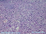 xanthogranuloma juvenile
