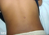xanthogranuloma juvenile
