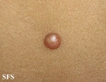 xanthogranuloma juvenile