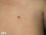 xanthogranuloma juvenile