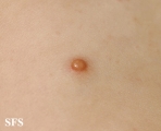 xanthogranuloma juvenile