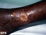 sickle cell anemia-leg ulcer