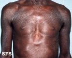 mycosis fungoides erythrodermic