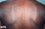 mycosis fungoides erythrodermic