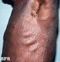 mycosis fungoides erythrodermic