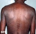 mycosis fungoides erythrodermic