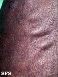 mycosis fungoides erythrodermic