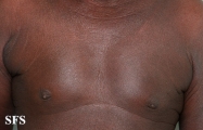 mycosis fungoides erythrodermic