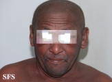 mycosis fungoides erythrodermic