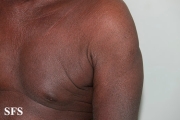 mycosis fungoides erythrodermic