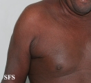 mycosis fungoides erythrodermic