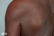 mycosis fungoides erythrodermic