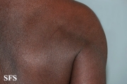 mycosis fungoides erythrodermic