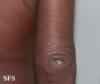 mycosis fungoides erythrodermic