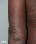 mycosis fungoides erythrodermic