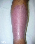 psoriasis-psoriasis after erysipelas