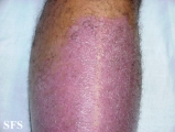 psoriasis-psoriasis after erysipelas