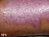 psoriasis-psoriasis after erysipelas