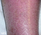 psoriasis-psoriasis after erysipelas