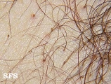 pediculosis pubis