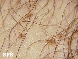 pediculosis pubis