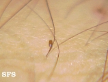 pediculosis pubis