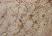 pediculosis pubis
