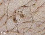 pediculosis pubis