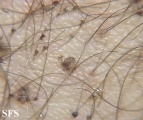 pediculosis pubis