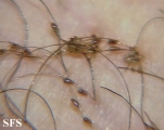 pediculosis pubis