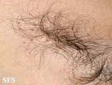 pediculosis pubis